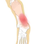 アキレス腱の痛みの場所イラスト