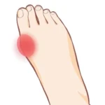 外反母趾の痛みイラスト