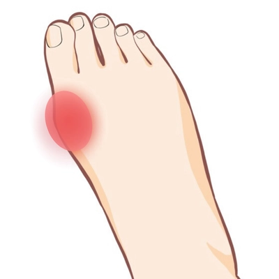 外反母趾の痛みの出る場所