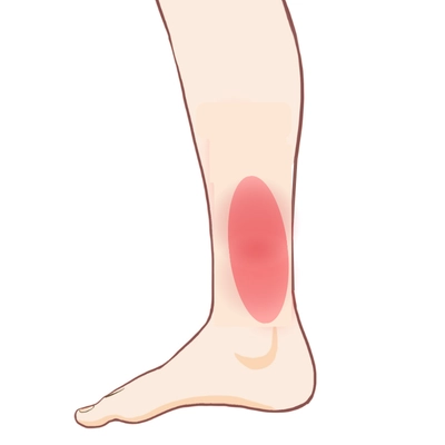 シンスプリント痛みのイラスト