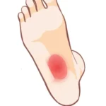 足底腱膜炎の痛みイラスト