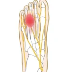 モートン病の痛みの位置イラスト