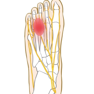モートン病で痛みが出てくる場所のイラスト