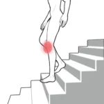 変形性膝関節症の痛みイラスト