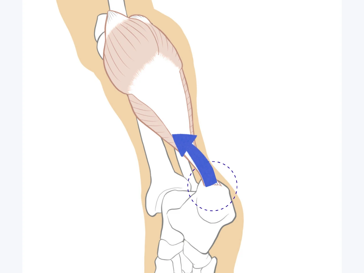 アキレス腱の牽引ストレスの図