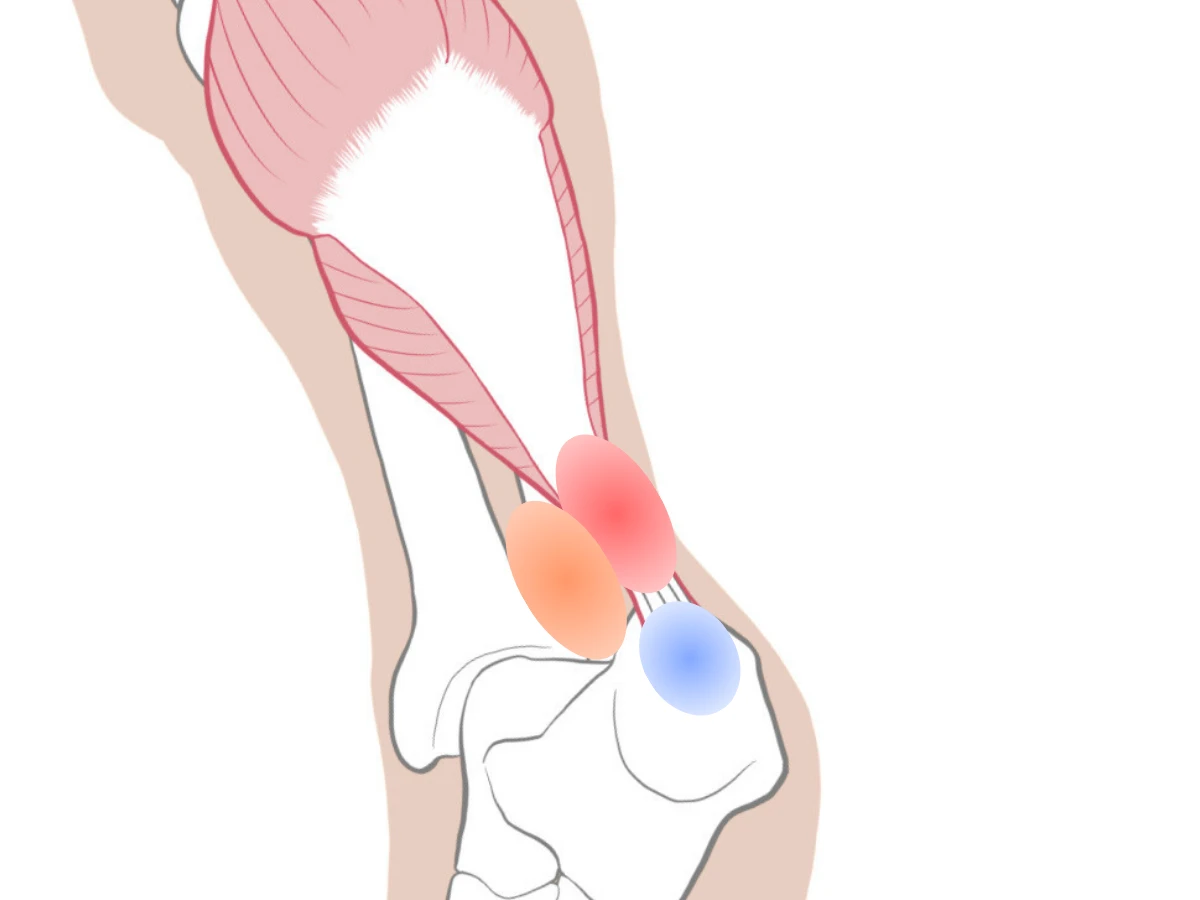 アキレス腱の痛み分布図