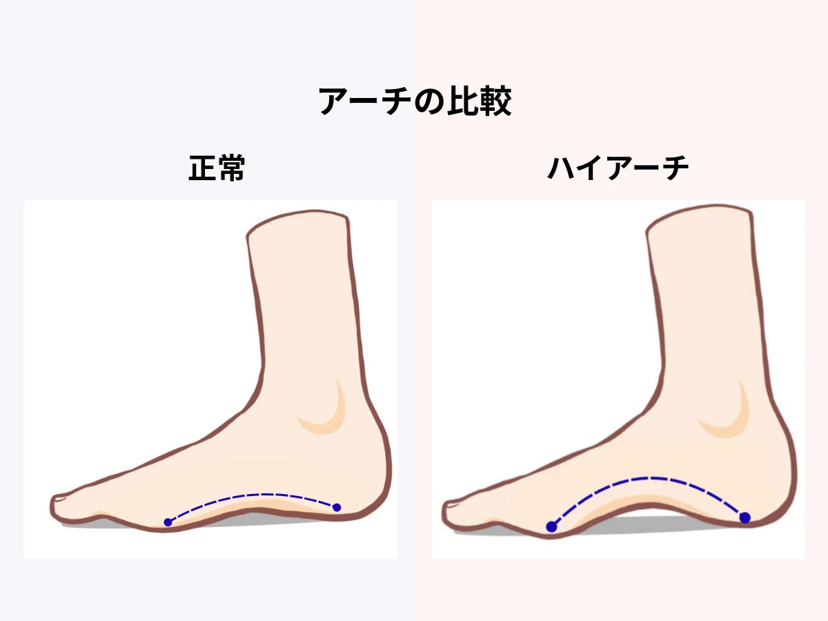 アーチの比較イラスト