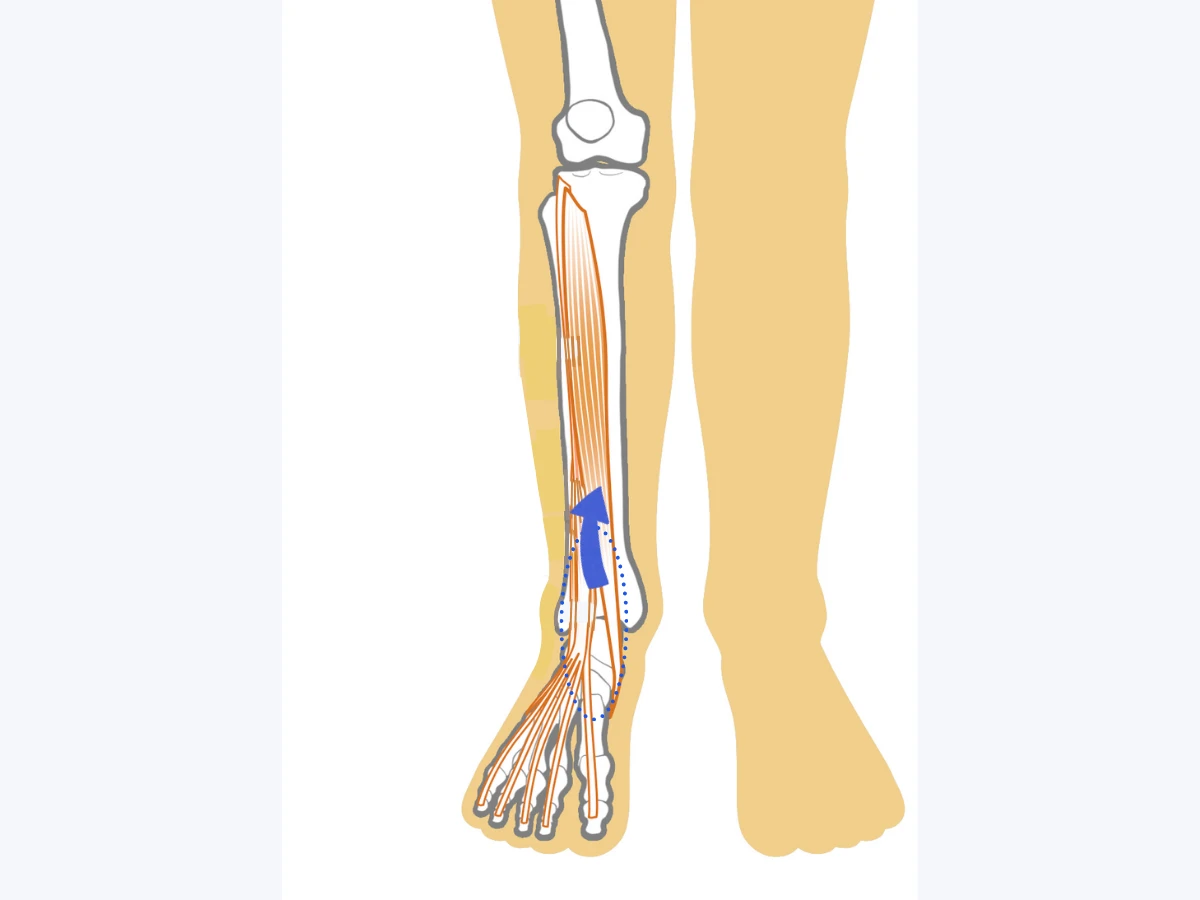 伸筋群の過緊張のイラスト
