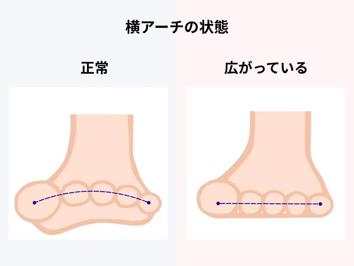 横アーチの状態のイラスト