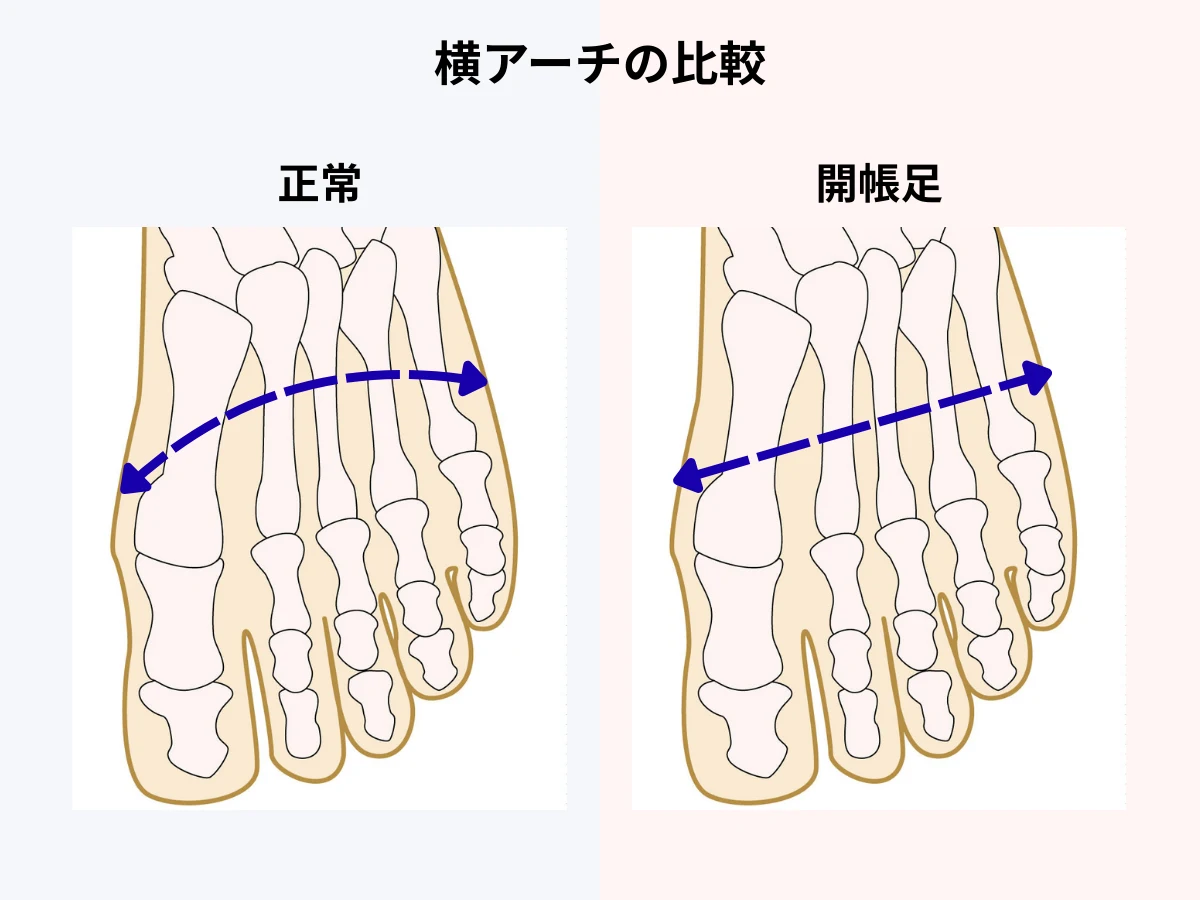 横アーチの比較イラスト