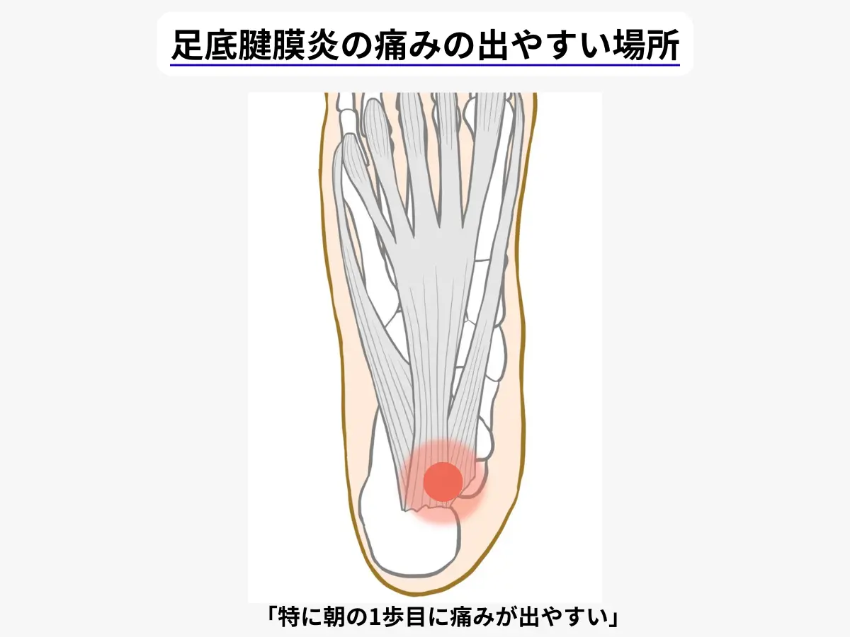 足底腱膜炎の痛みの出やすい場所