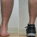 足の状態比較写真