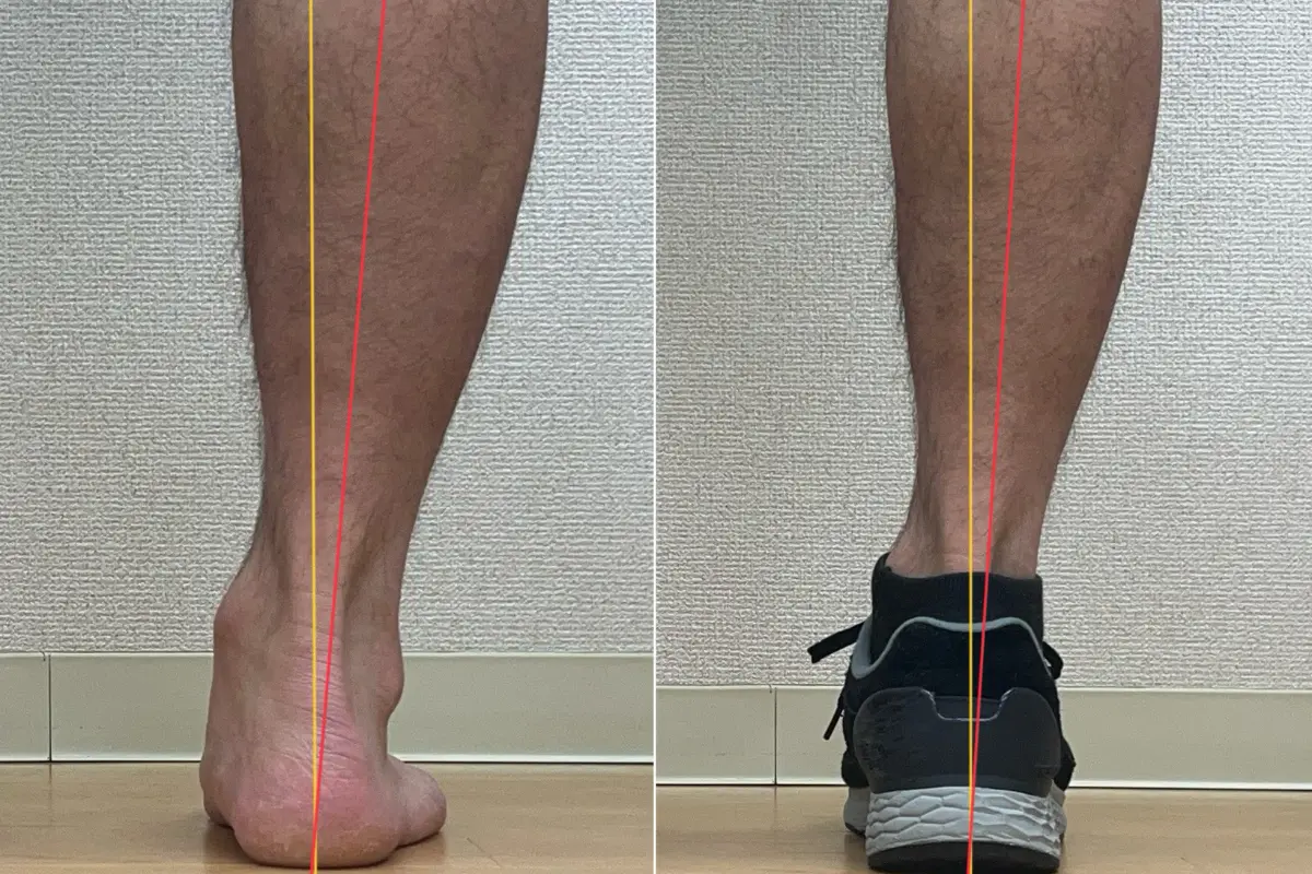 足の状態比較写真