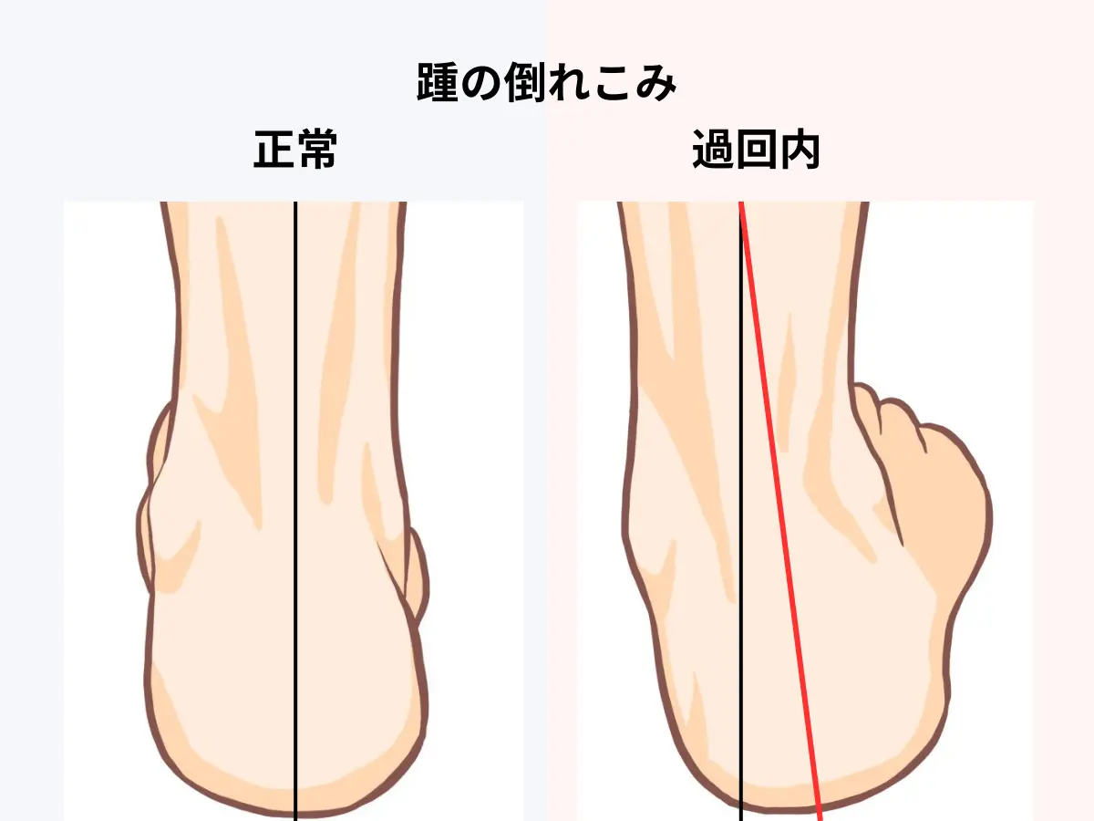 踵の倒れこみイラスト