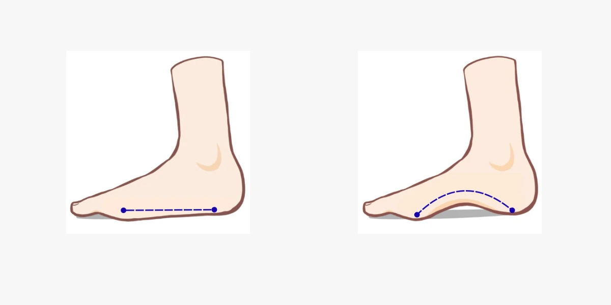 扁平足とハイアーチ