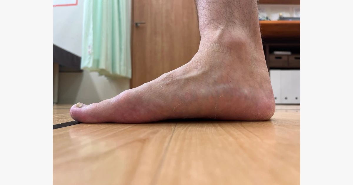 足のアーチの状態
