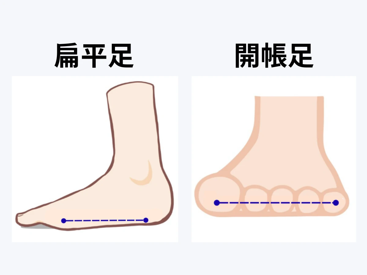 扁平足と開帳足イラスト
