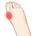 外反母趾イラスト